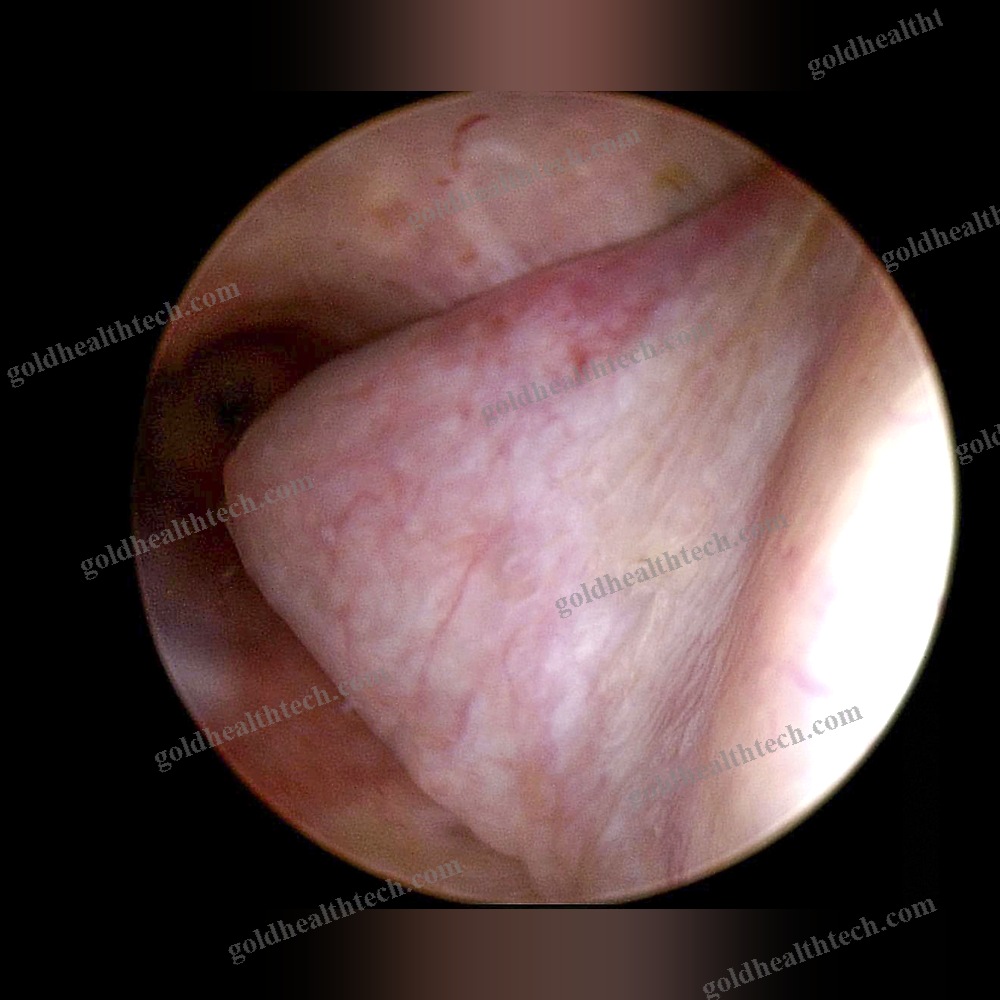 Endoscope Camera Head
