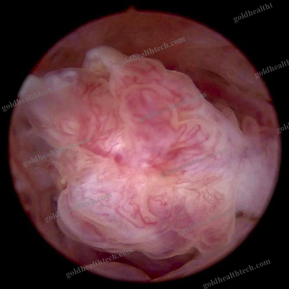 Endoscope Camera Head