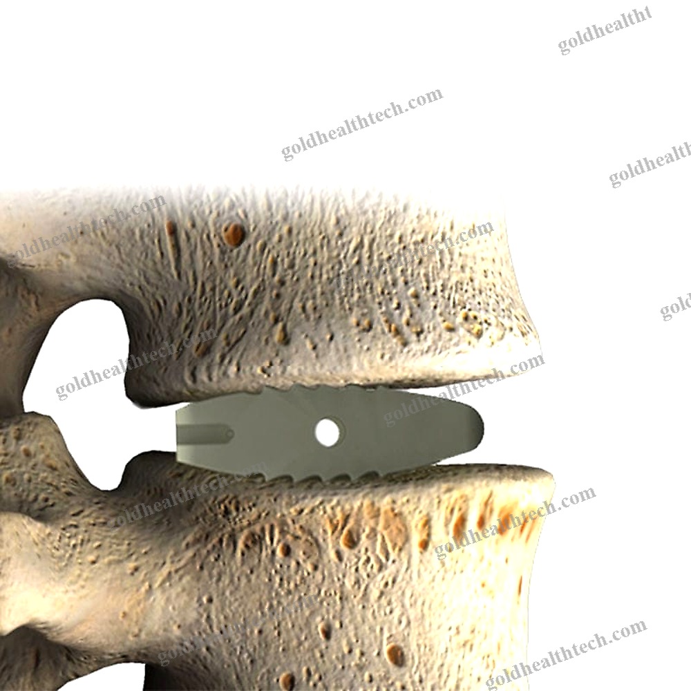 Lumbar Interbody Fusion Cage