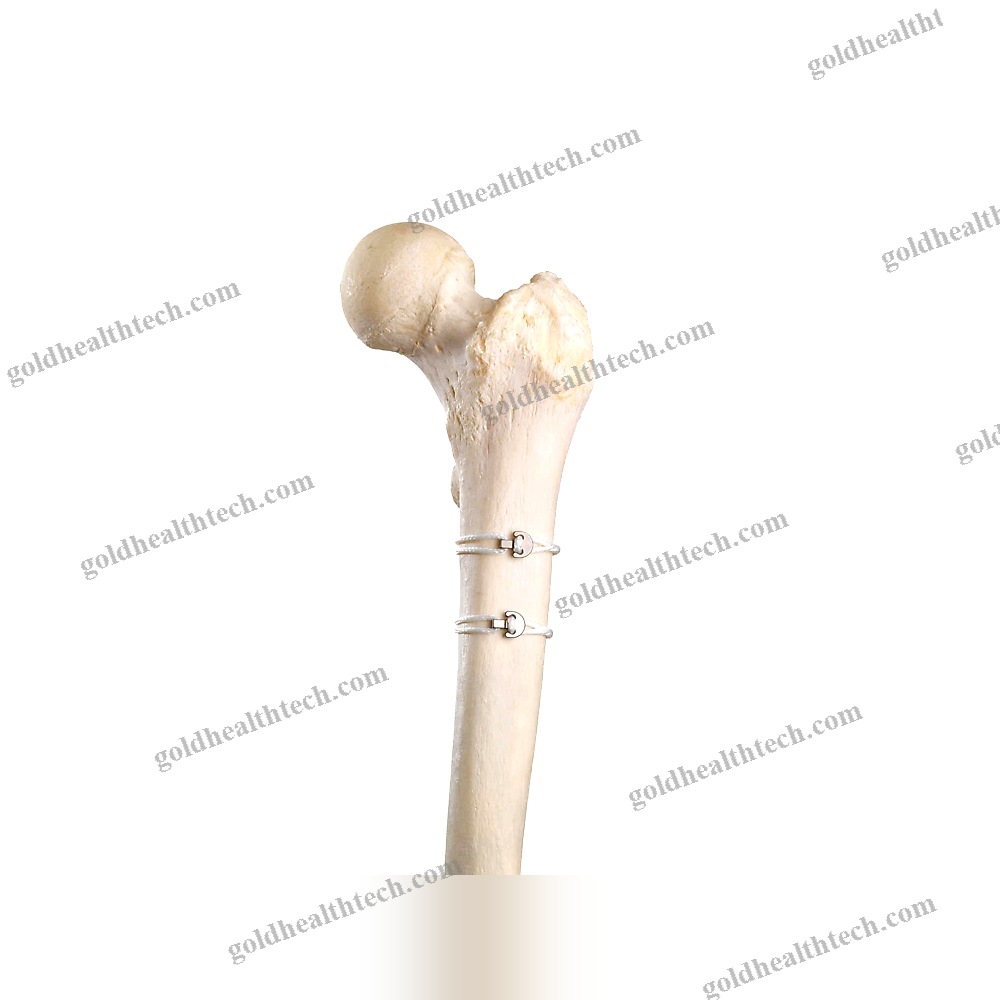 Multifilament Polymer Bone Cerclage