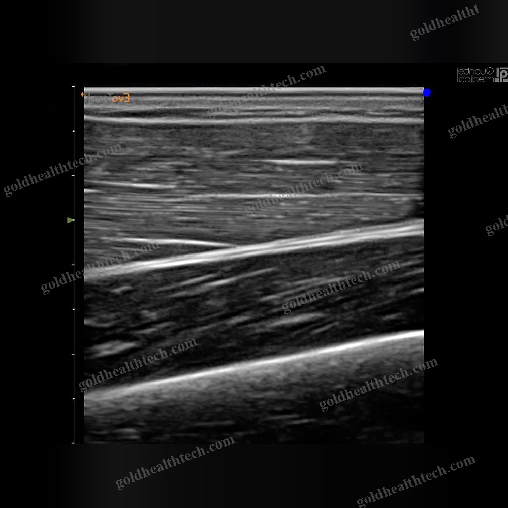 Portable Ultrasound System