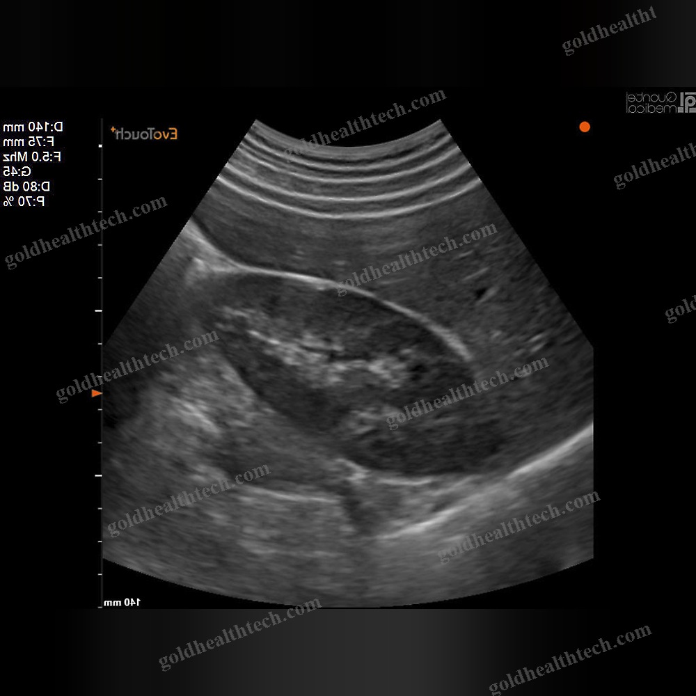 Portable Ultrasound System