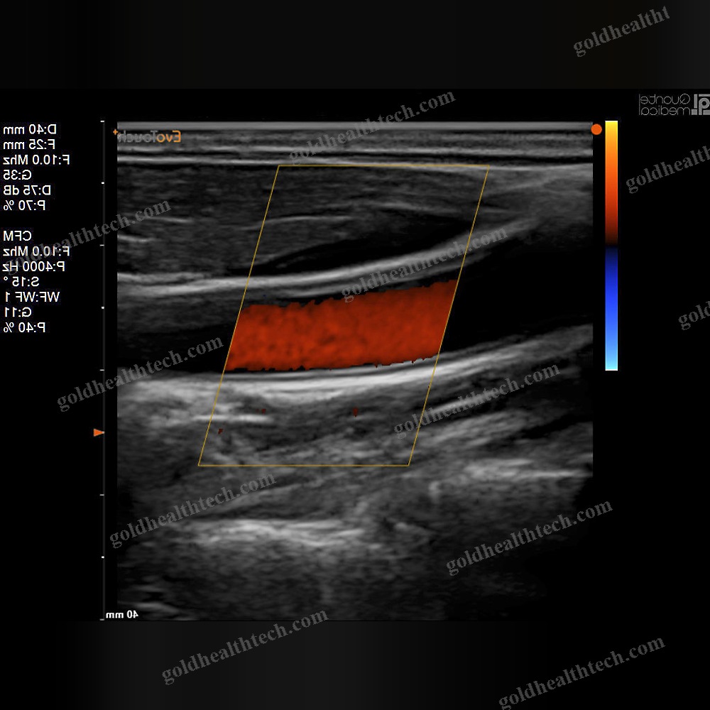 Portable Ultrasound System
