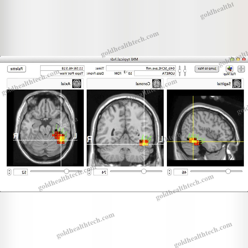 Eeg System With Mapping