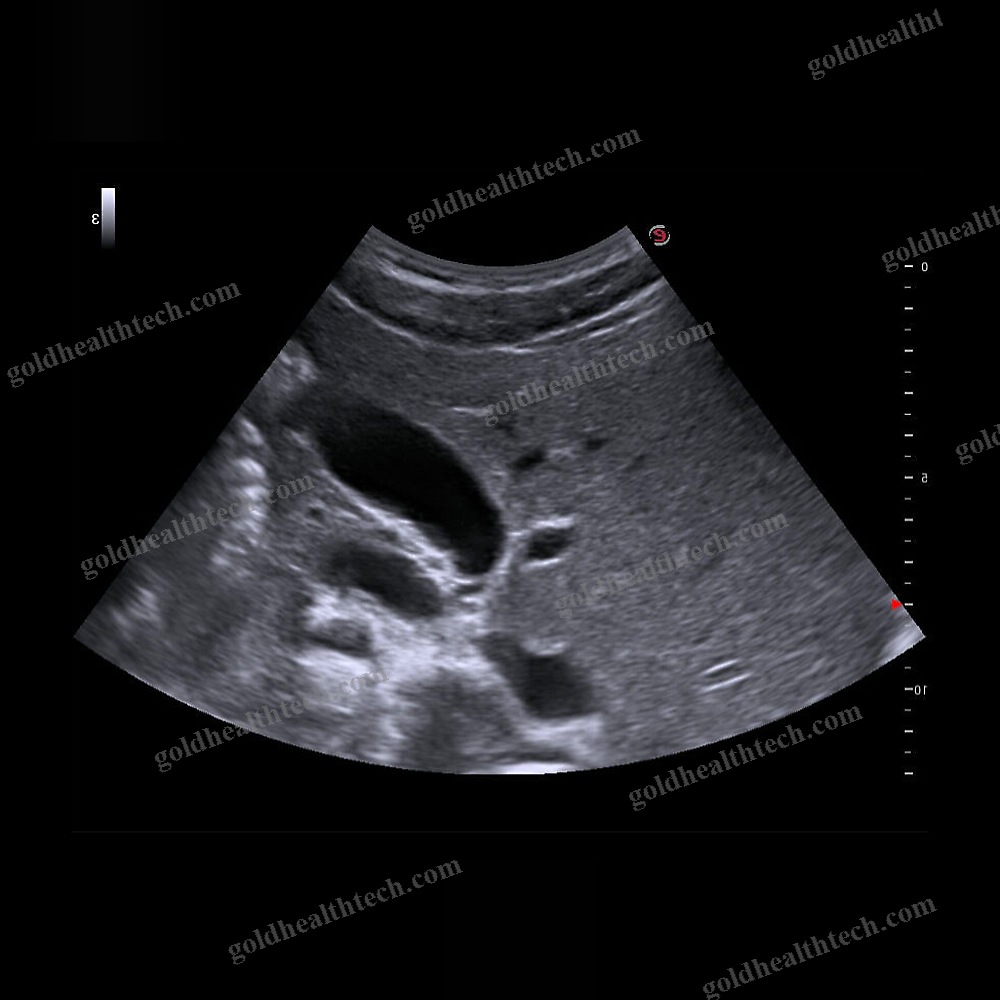 Hand-Held Ultrasound System