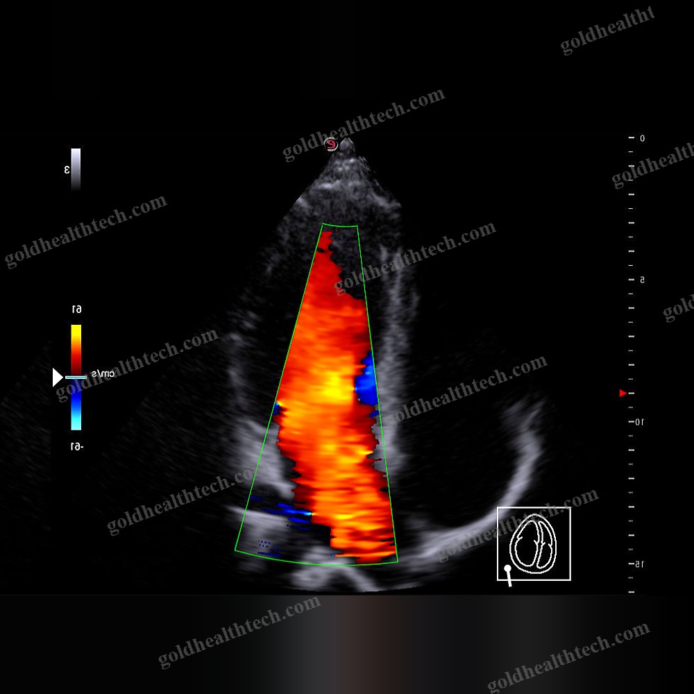 Hand-Held Ultrasound System