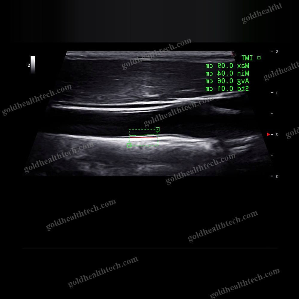 Hand-Held Ultrasound System