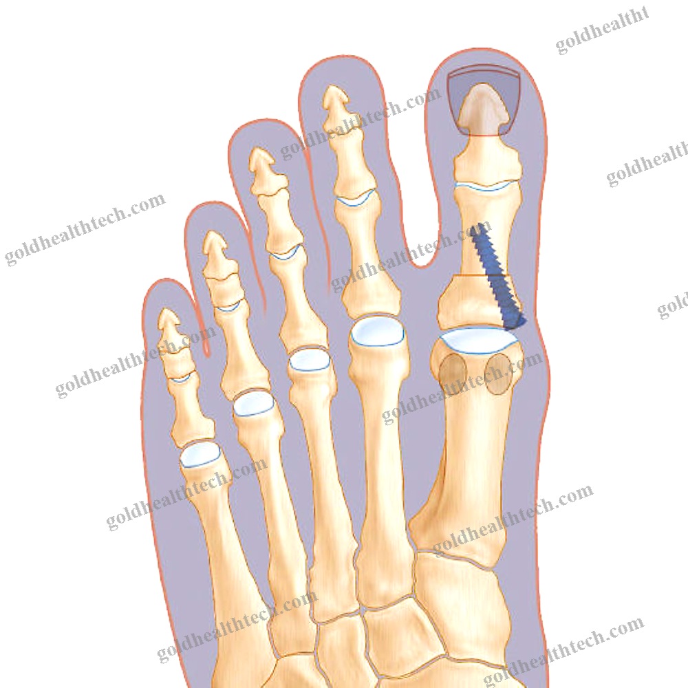 Hallux Valgus Arthrodesis Screw