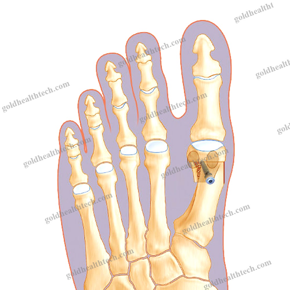 Hallux Valgus Arthrodesis Screw