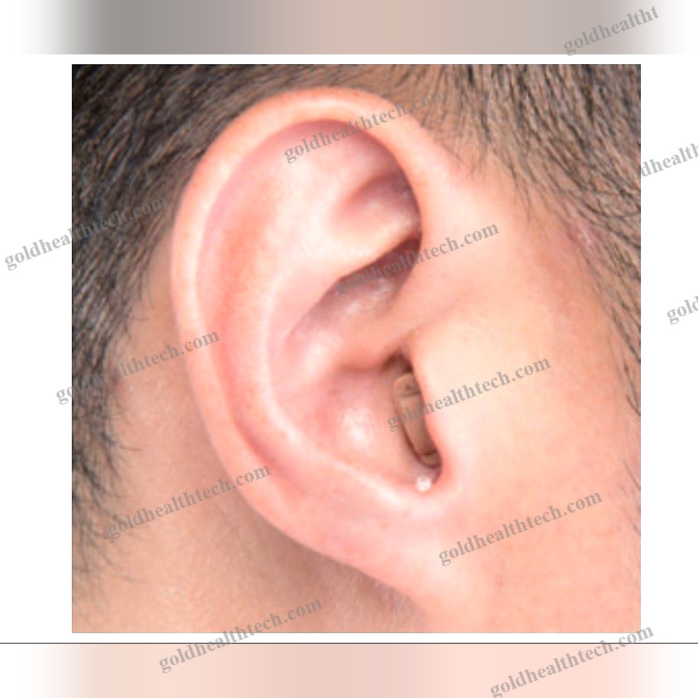 Itc Hearing Aid