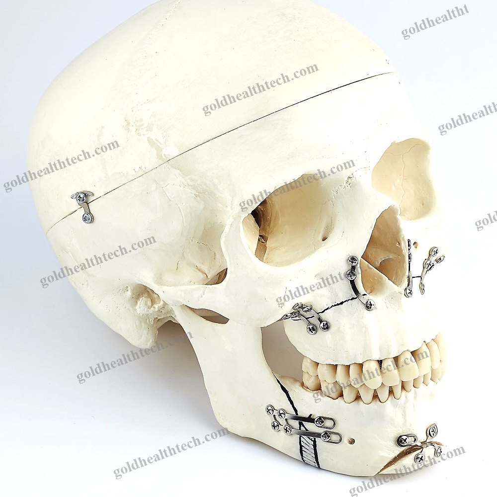 Genioplasty Compression Plate