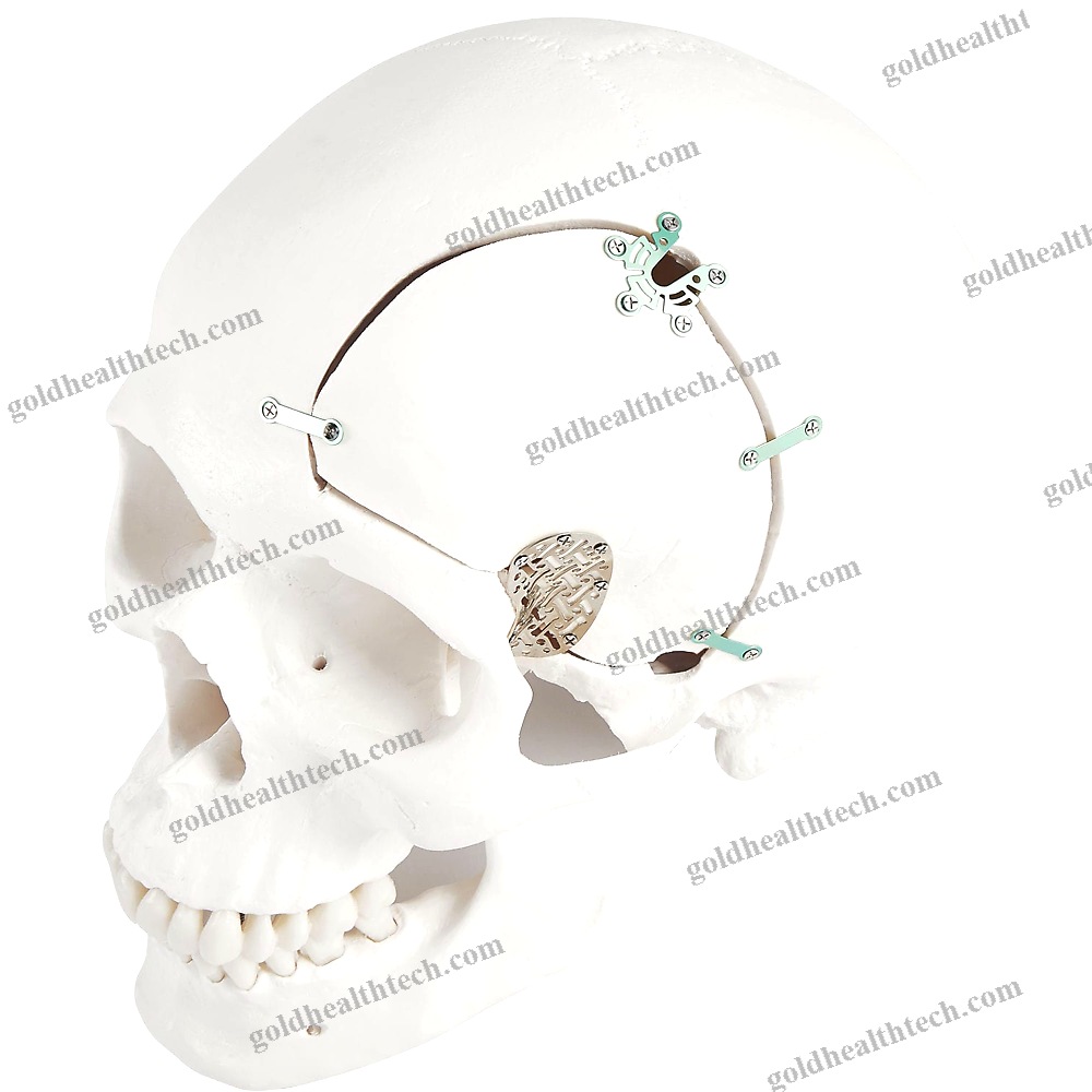 Non-Absorbable Cranial Fixation System
