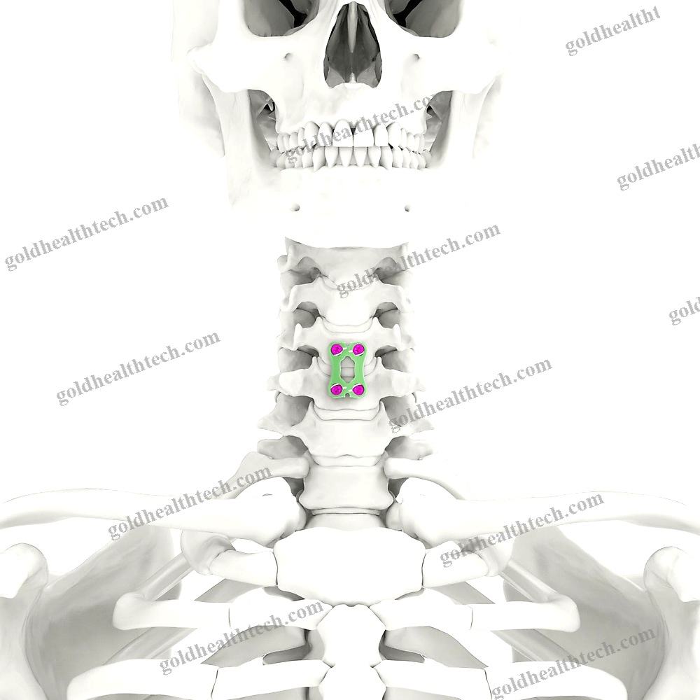 Cervical Arthrodesis Plate