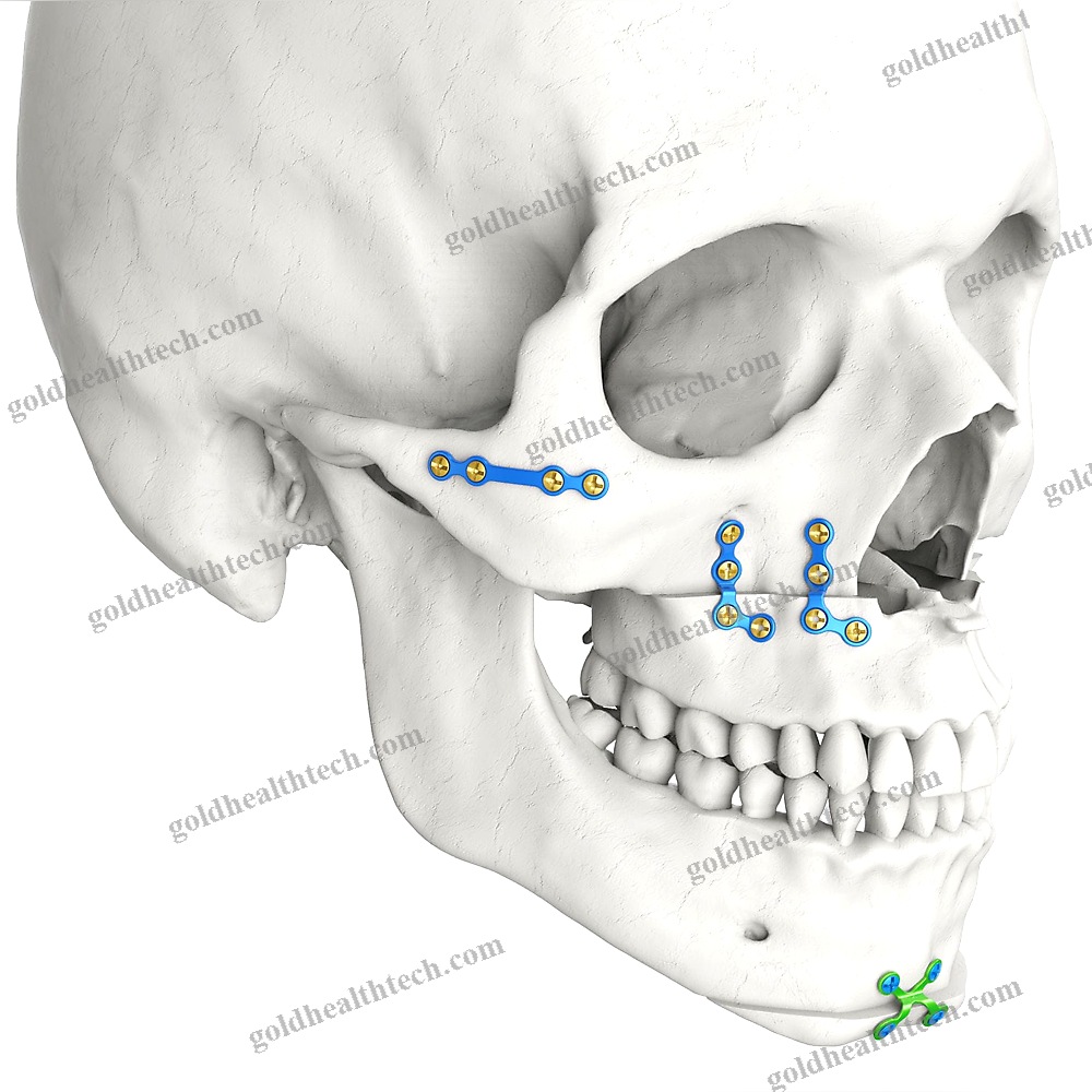 Genioplasty Compression Plate