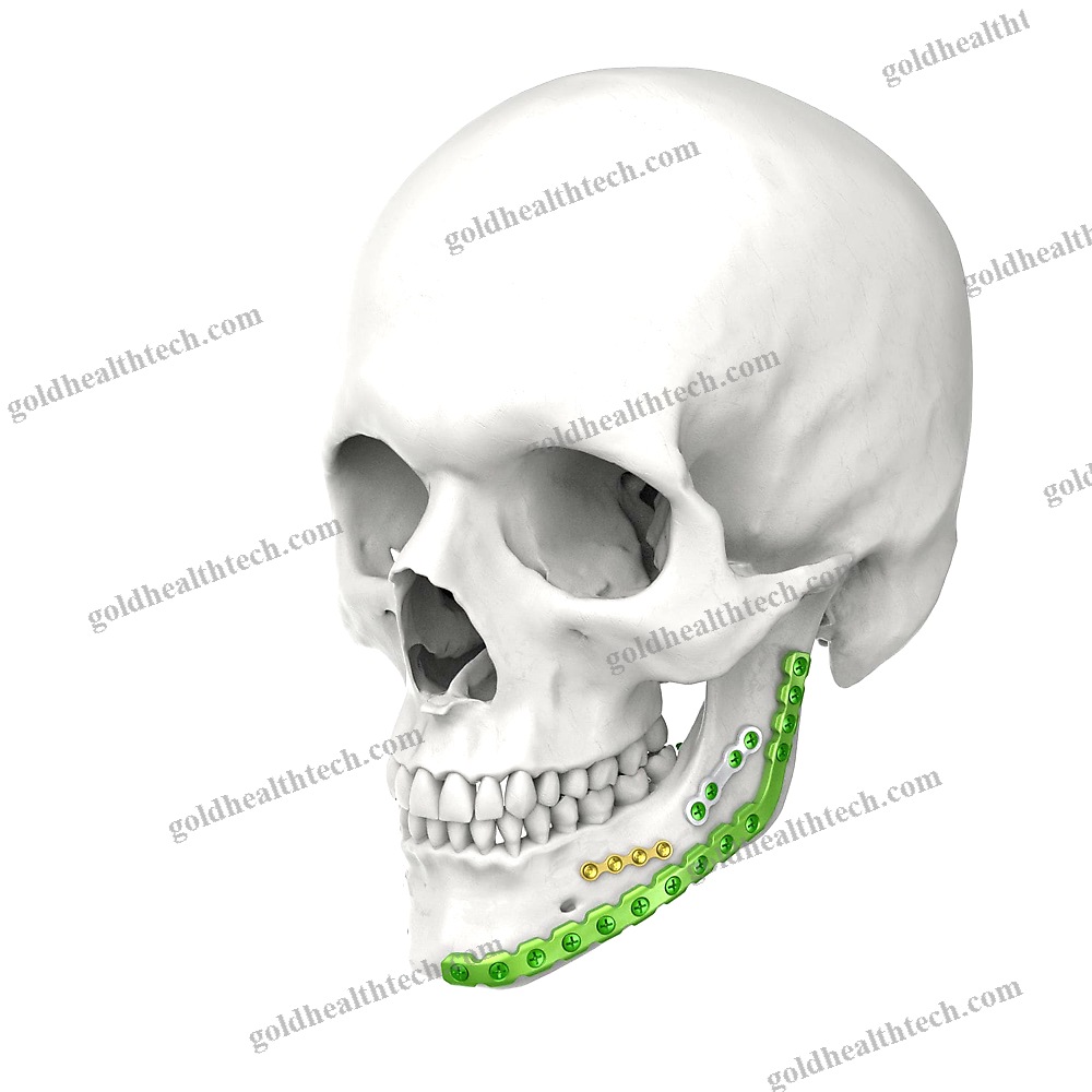 Mandible Compression Plate