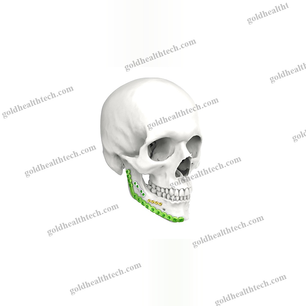 Mandible Compression Plate