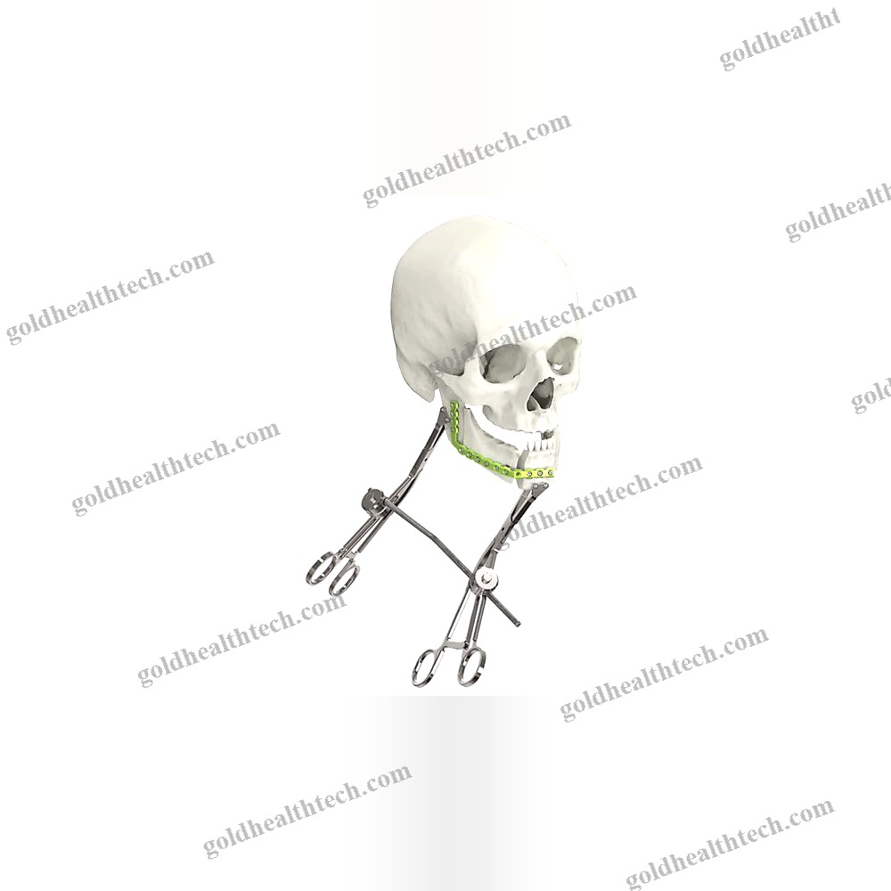Mandible Compression Plate