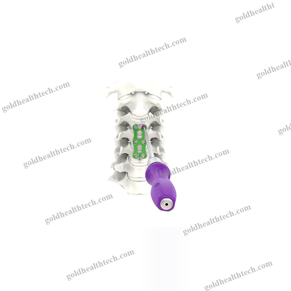 Cervical Arthrodesis Plate