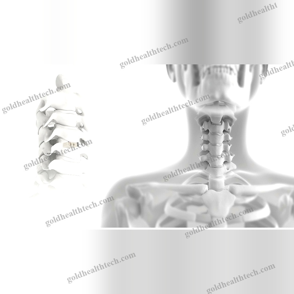 Cervical Interbody Fusion Cage