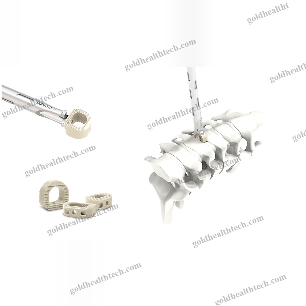 Cervical Interbody Fusion Cage