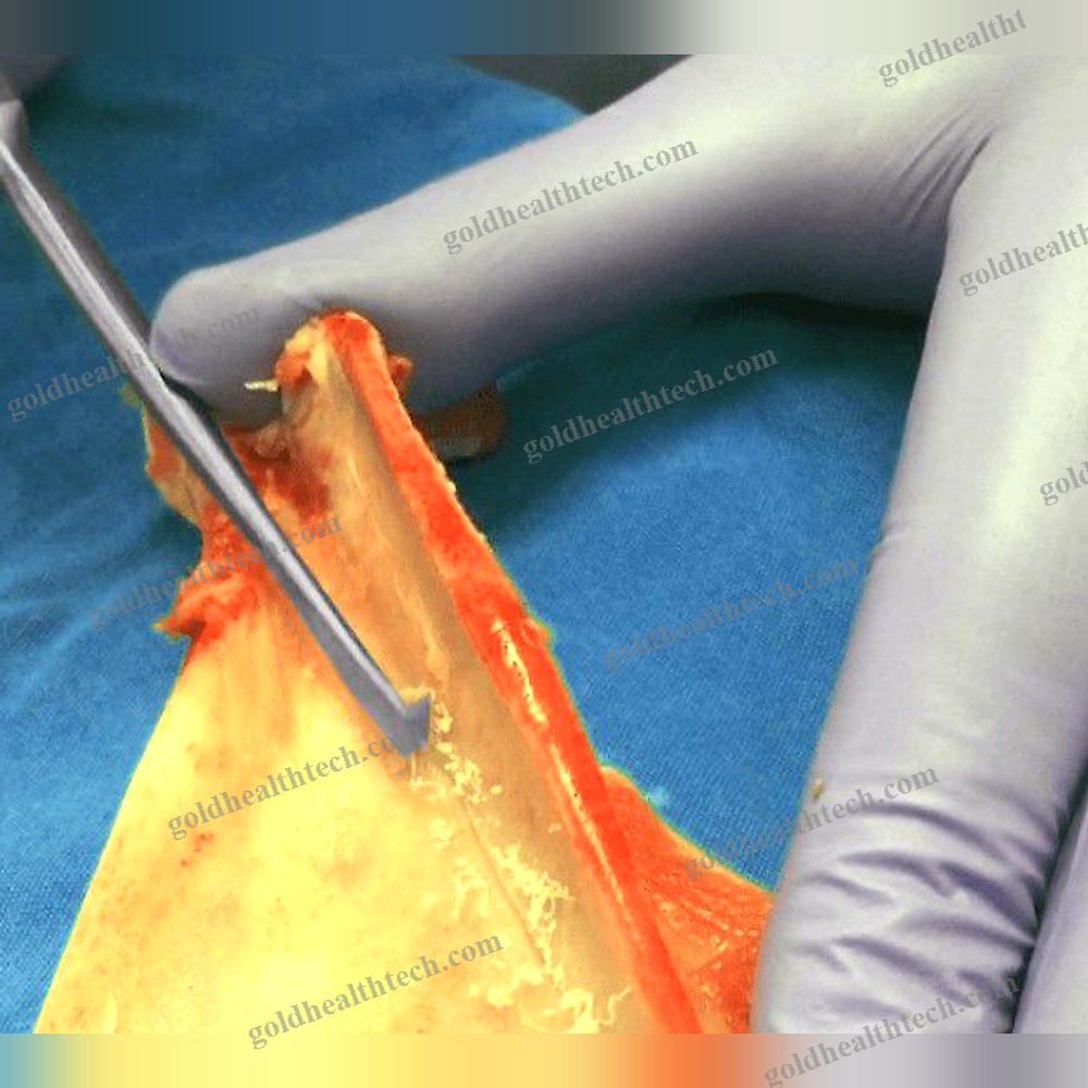 Nasal Orthopedic File