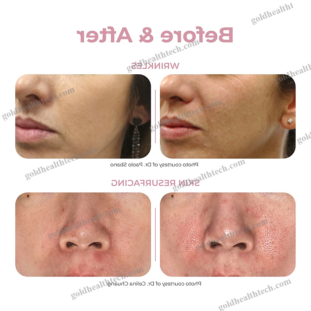 Tattoo Removal Laser