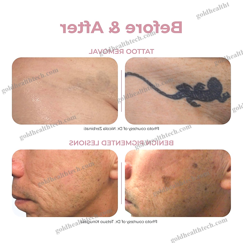 Tattoo Removal Laser