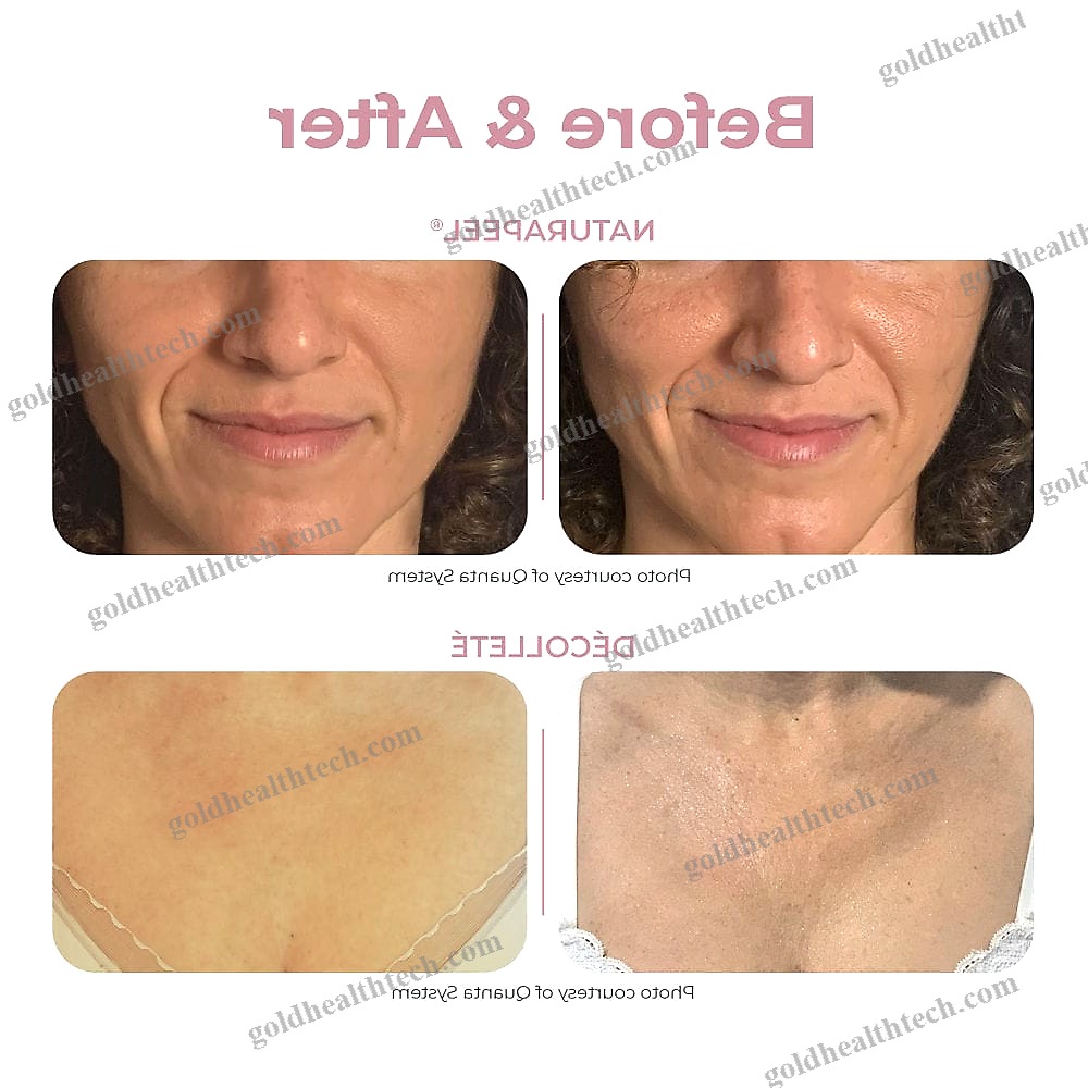 Pigmented Lesion Treatment Laser