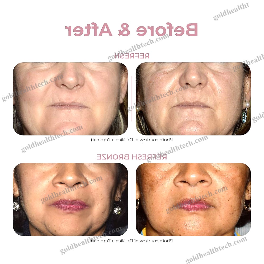 Pigmented Lesion Treatment Laser