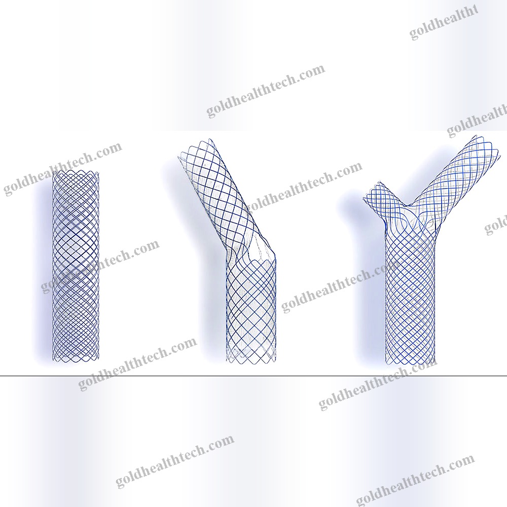 Bronchial Stent