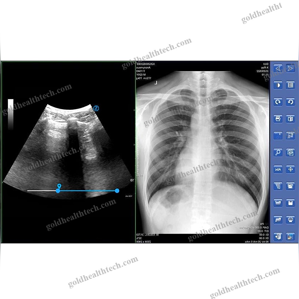 Portable Radiography System