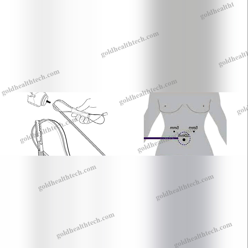 Laparoscopic Surgery Retrieval Pouch