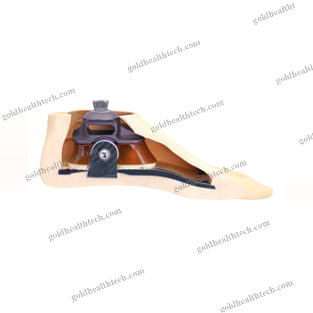 Sach Prosthetic Foot