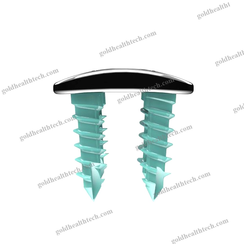 Cervical Arthrodesis Plate