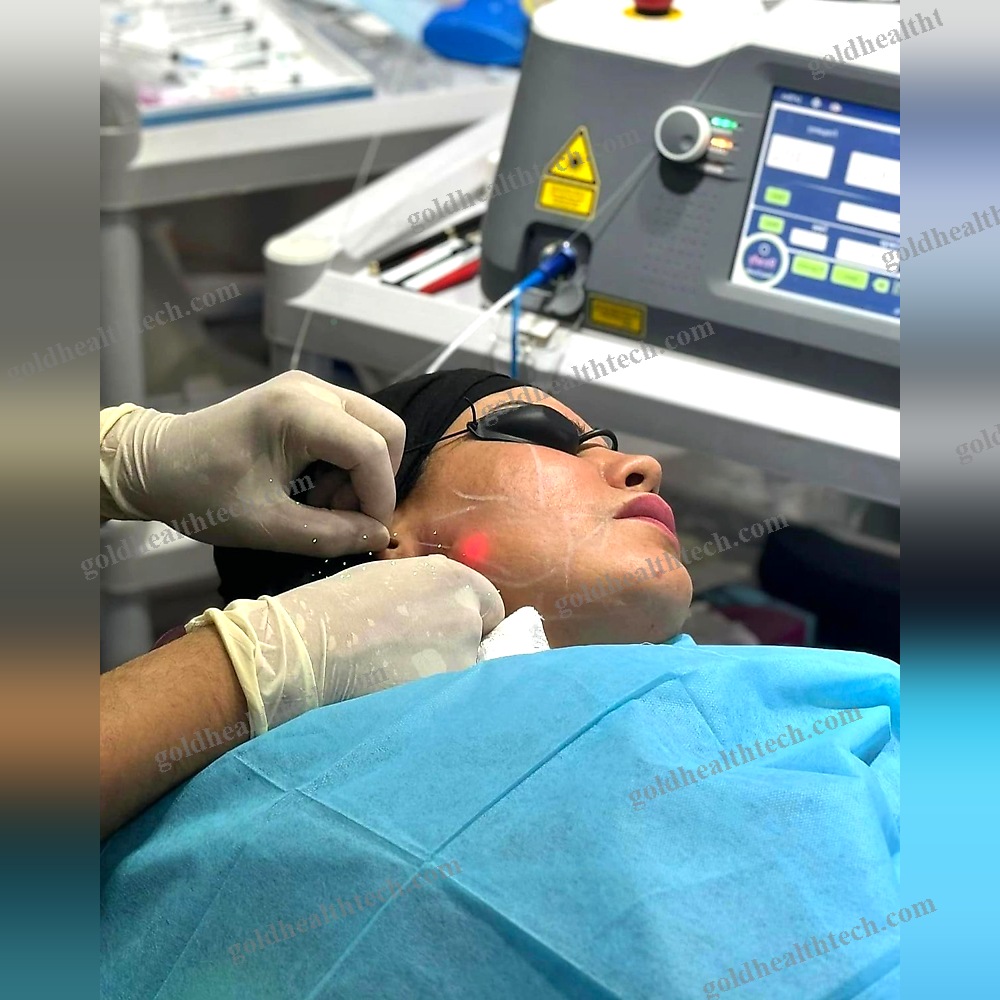 Surgical Laser
