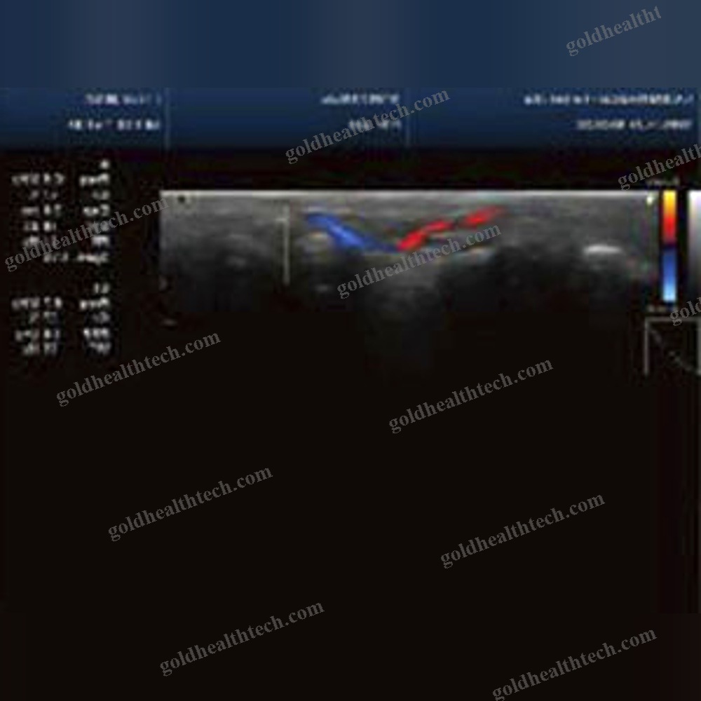 Portable Ultrasound System
