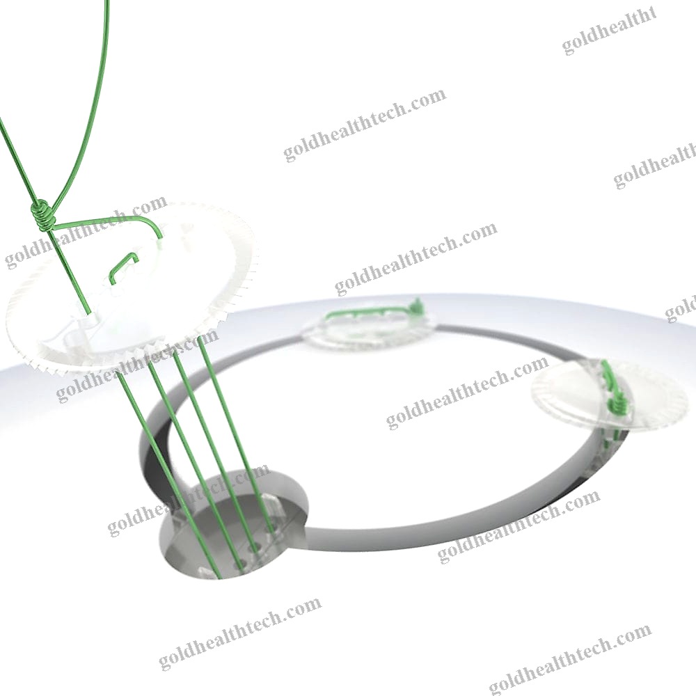 Absorbable Cranial Fixation System