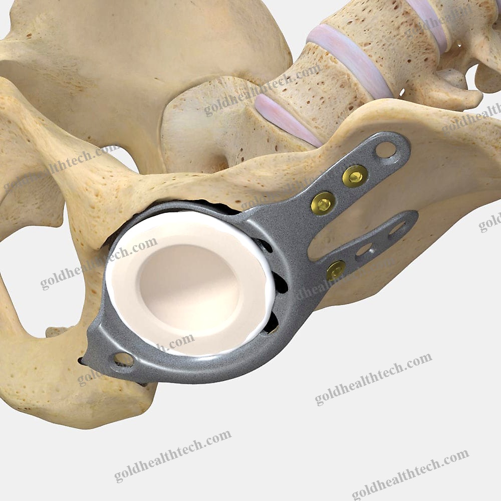 Acetabular Reinforcement