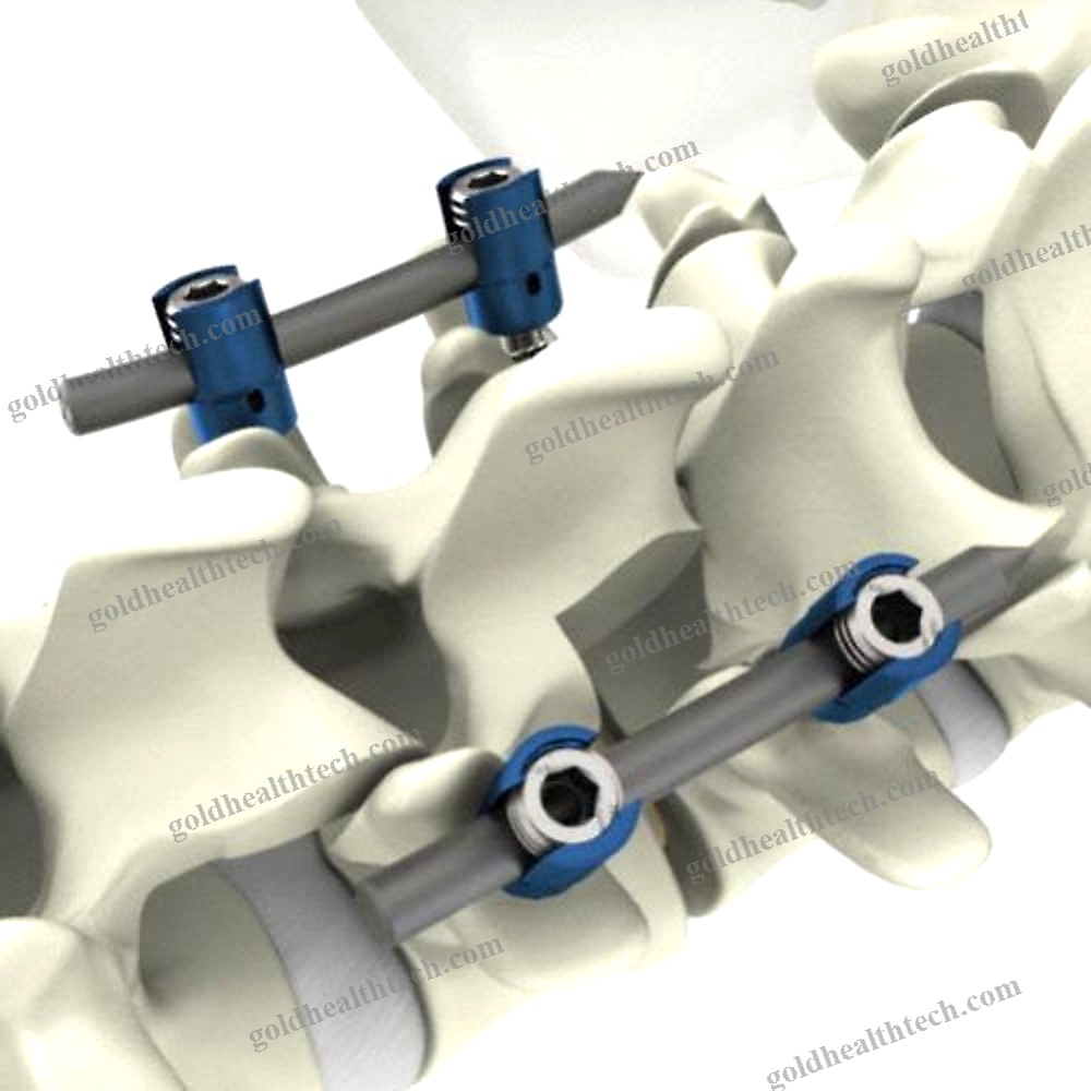 Thoraco-Lumbar Osteosynthesis Unit