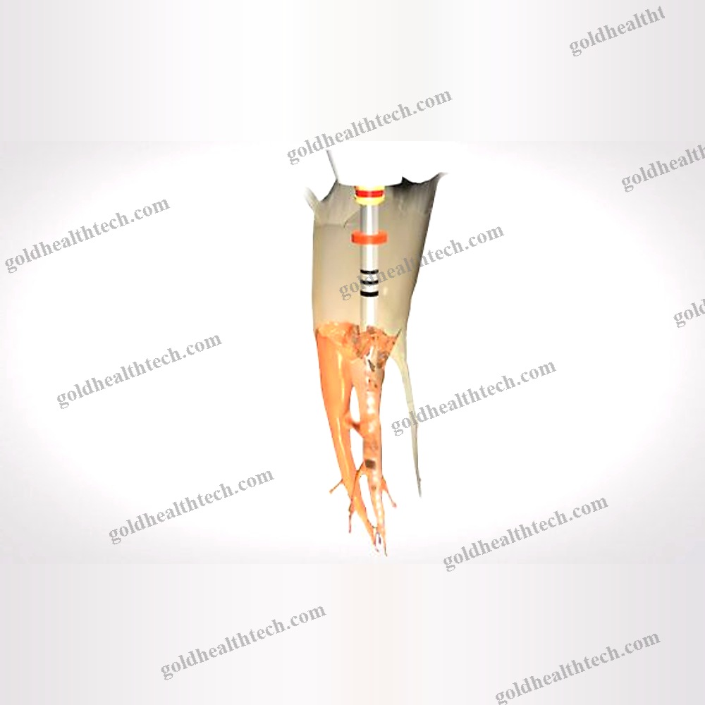 Gutta-Percha Root Canal Obturator
