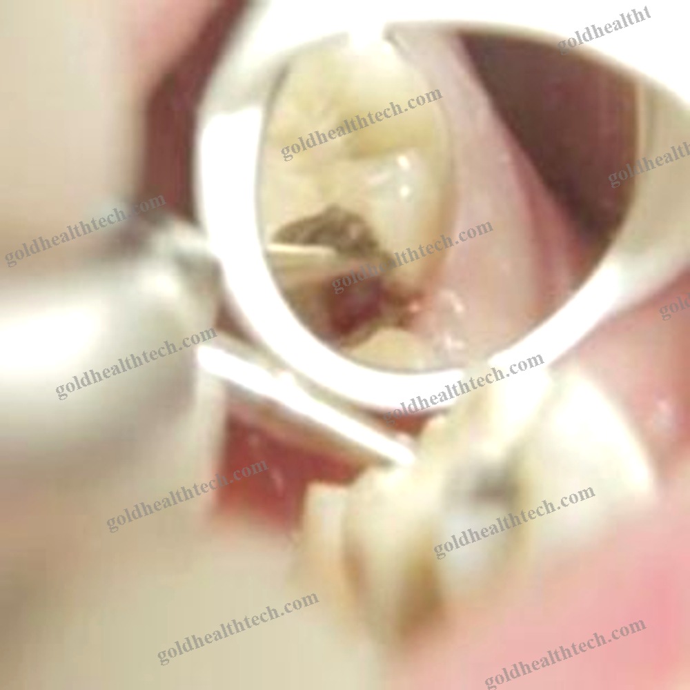 Dental Mirror
