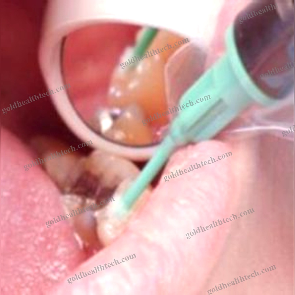Dental Mirror