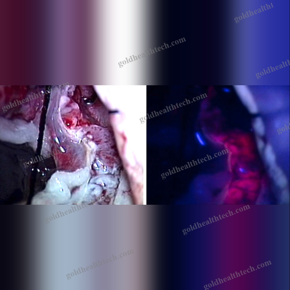 Operating Microscope Video Camera