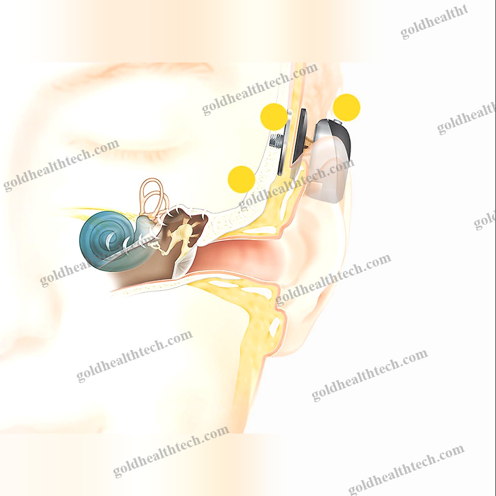 Body-Worn Processor Bone Conduction Implant