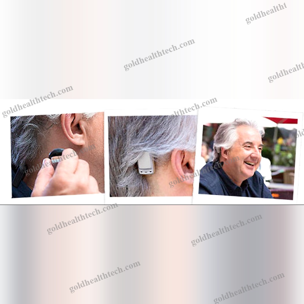 Body-Worn Processor Bone Conduction Implant