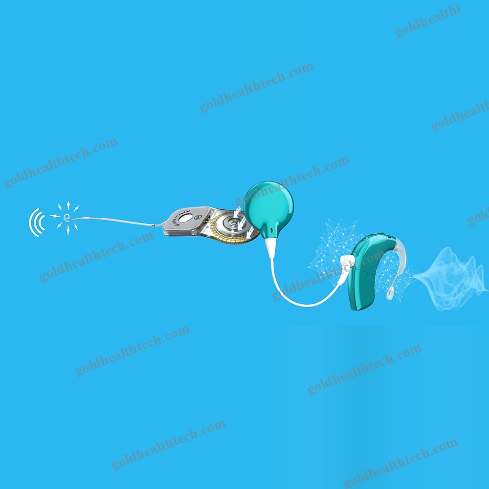 Behind-The-Ear Processor Cochlear Implant