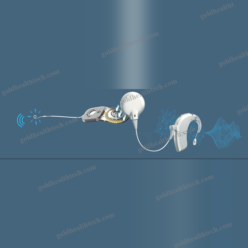 Behind-The-Ear Processor Cochlear Implant