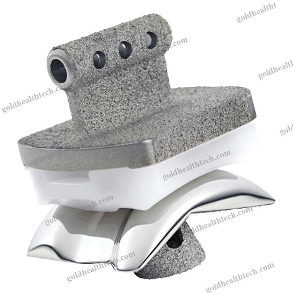 Cementless Total Ankle Prosthesis