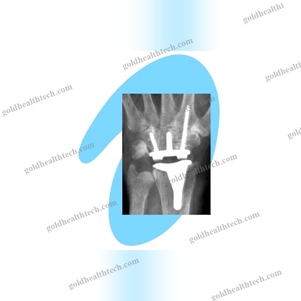Cemented Wrist Prosthesis