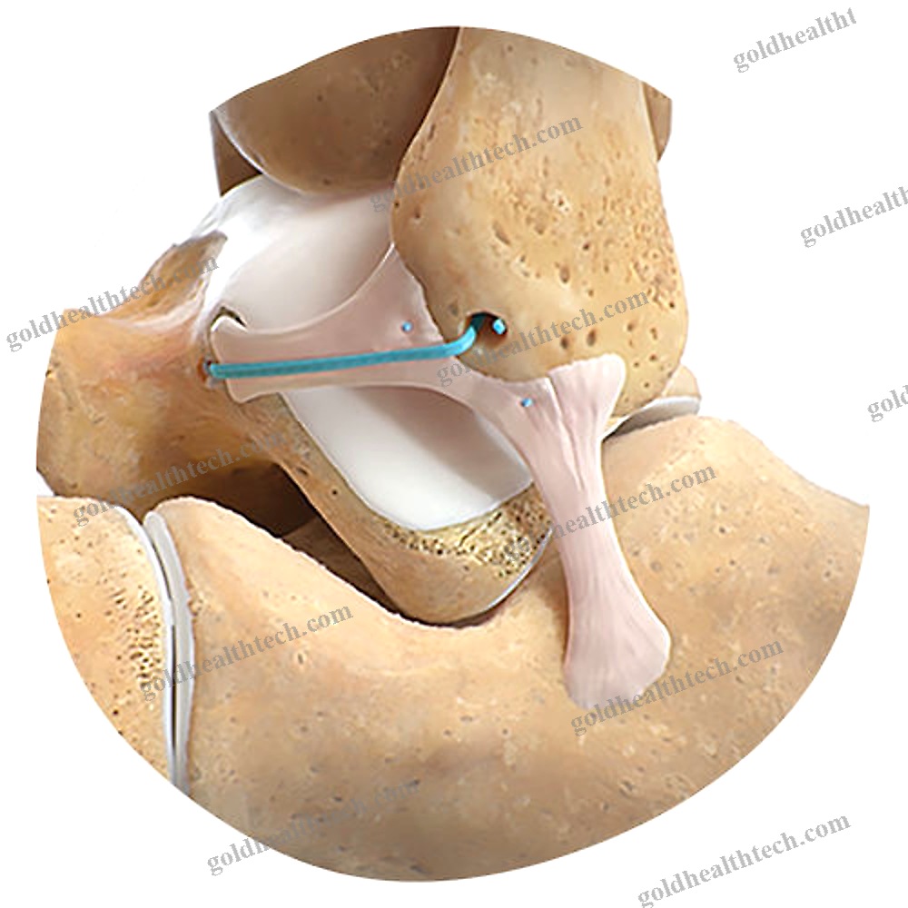 Rotator Cuff Suture Anchor